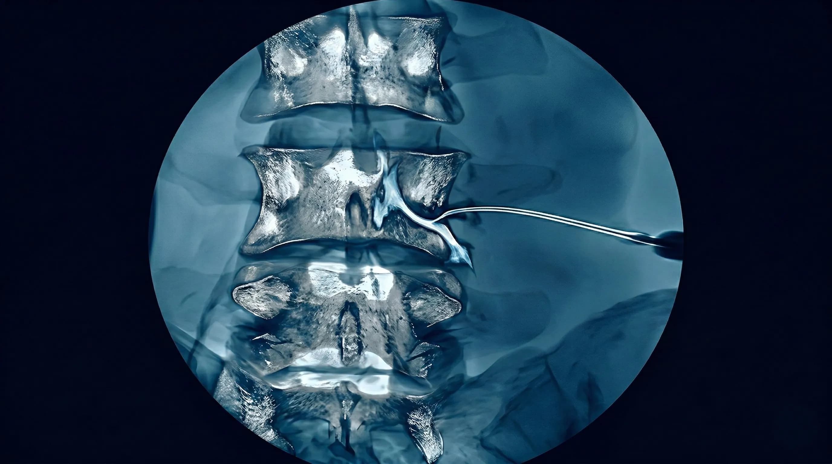 💉 Bloqueio Transforaminal Lombar (BTF)