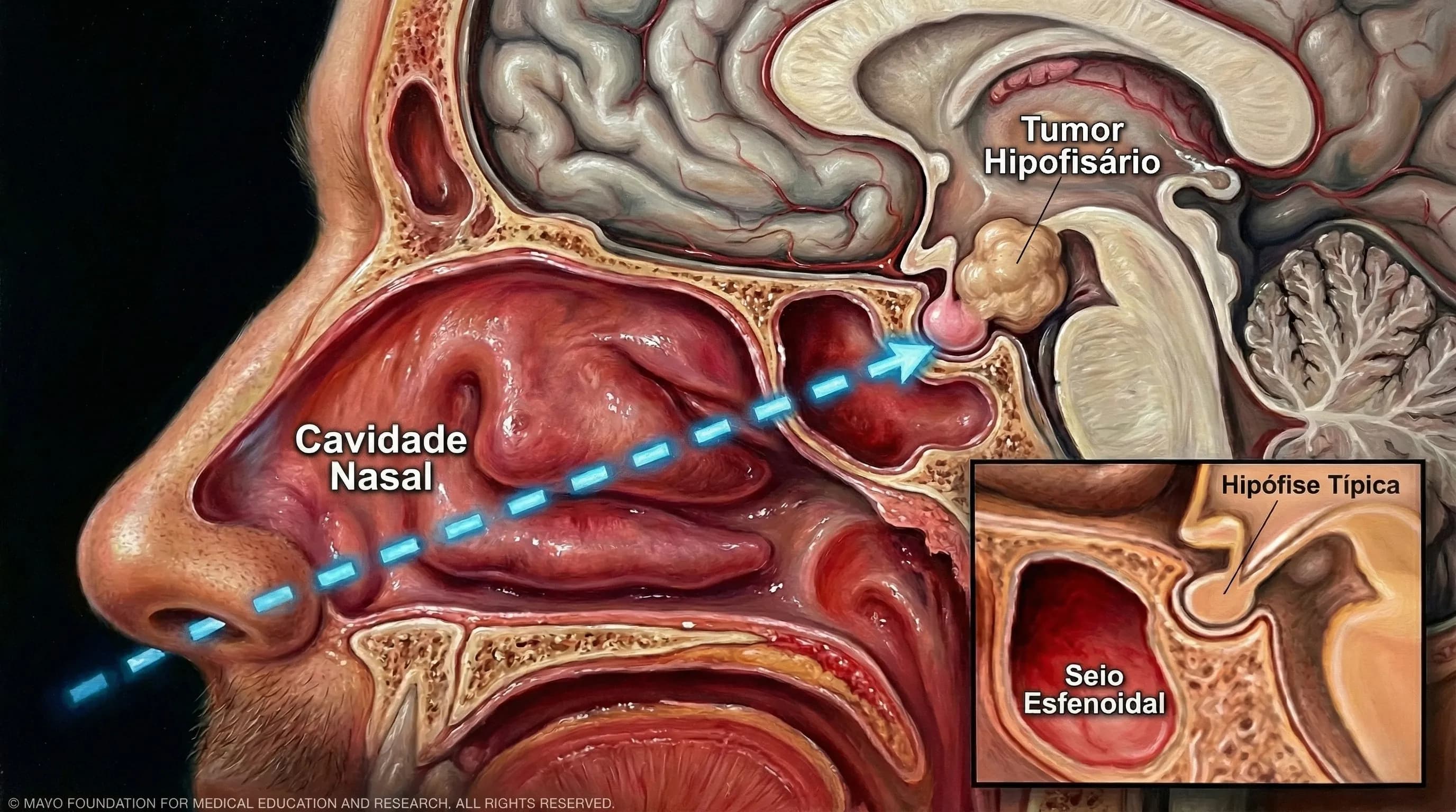 👃 Ressecção de Adenoma Hipofisário Endoscópica