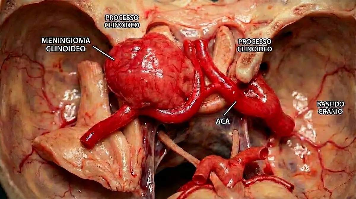 🦴 Ressecção de Meningioma do Clinóide Anterior