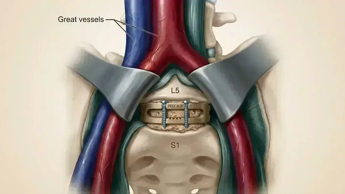 Artrodese lombar alif