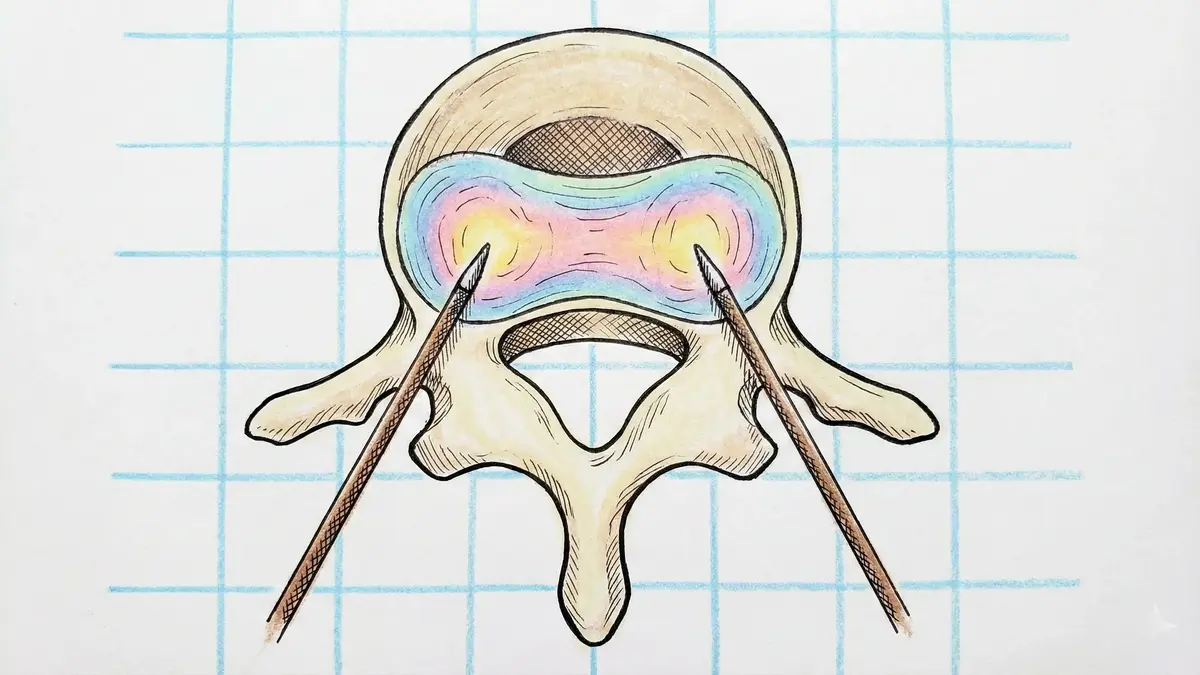 Biacuplastia Discal Lombar por Radiofrequência Bipolar