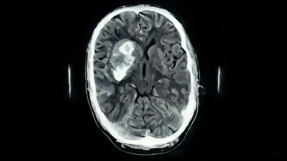 Craniotomia para Hematoma Intraparenquimatoso