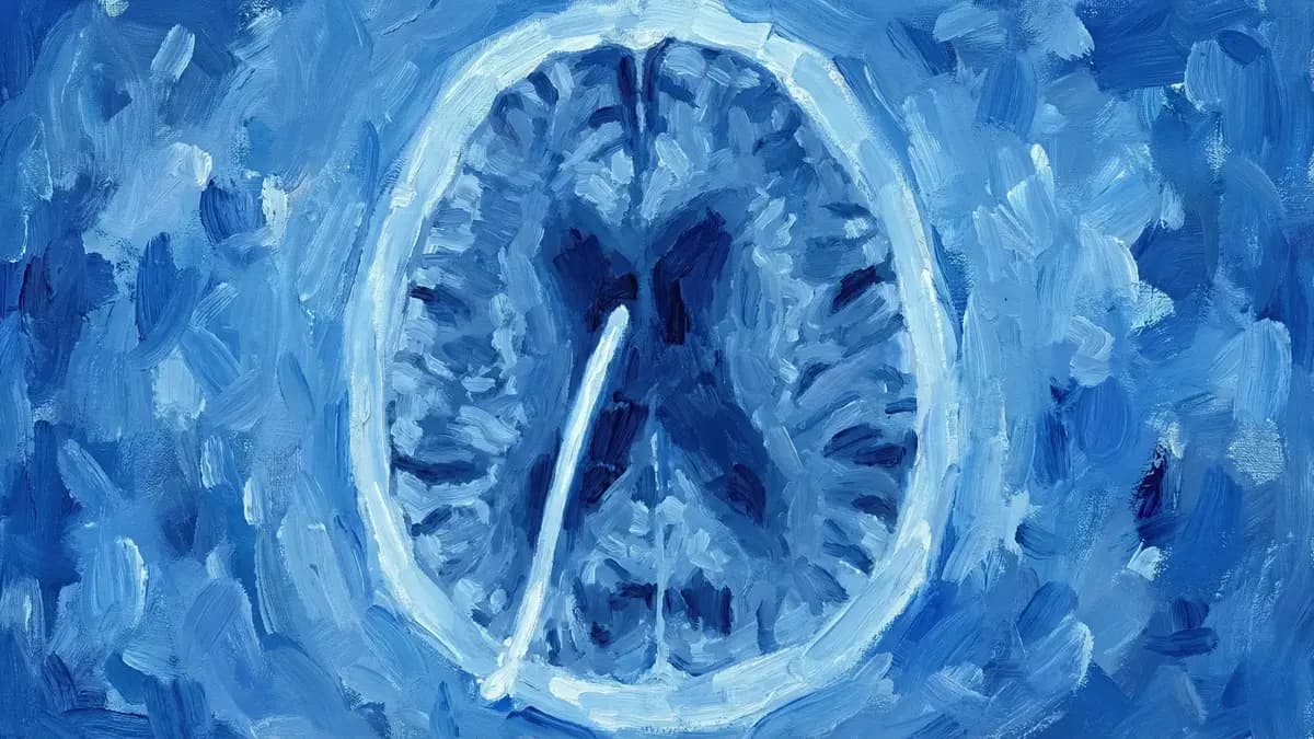 Derivação Ventrículo-Peritoneal (DVP)