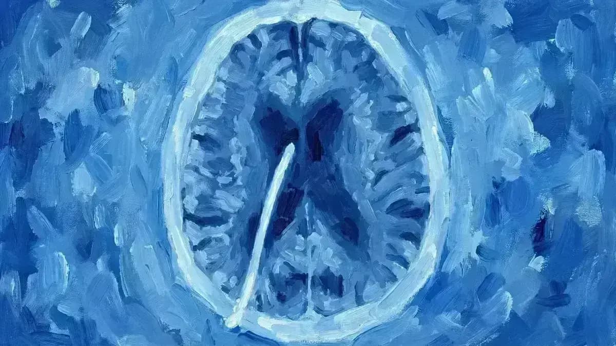 Derivação Ventrículo-Peritoneal (DVP)