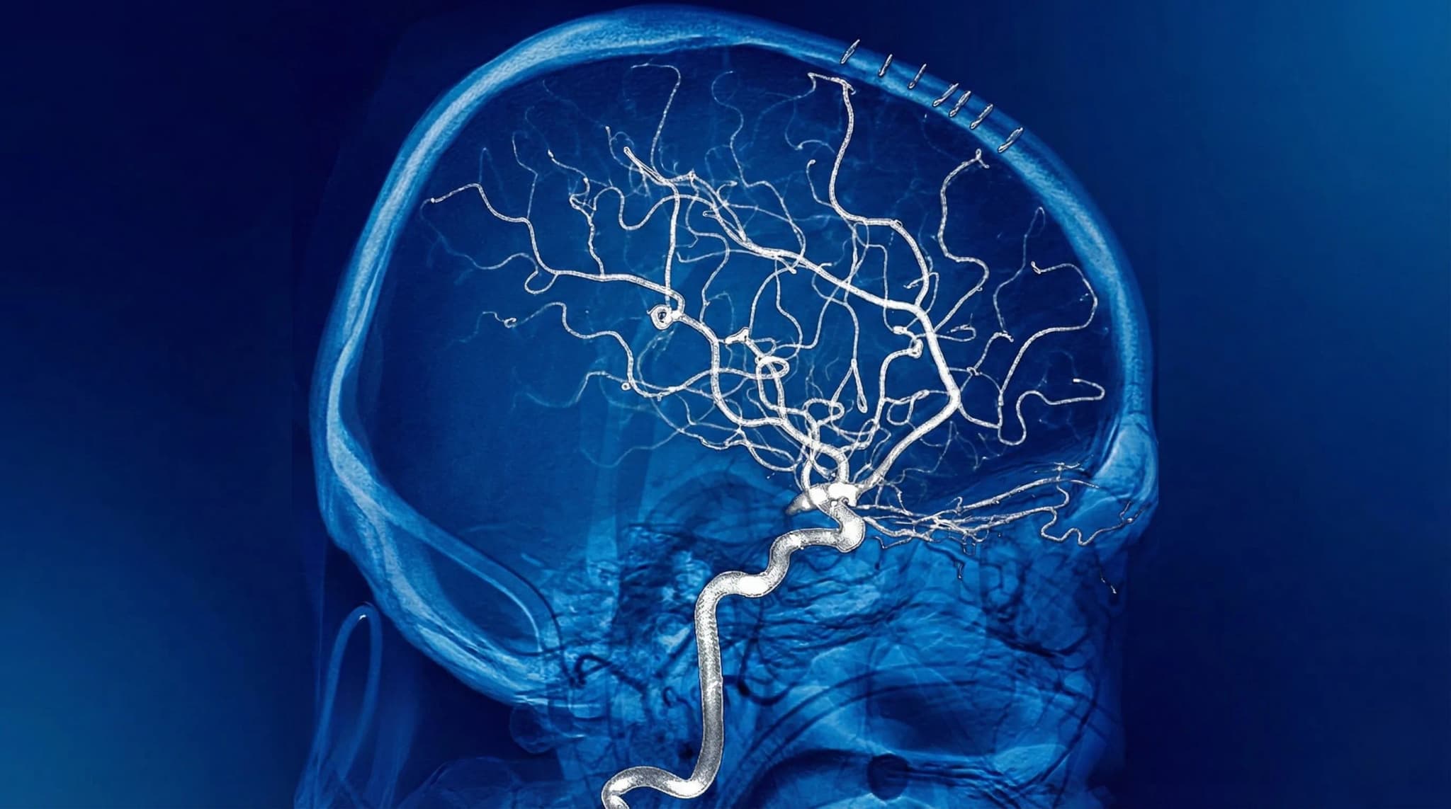 Embolização Endovascular de MAV ou Aneurisma