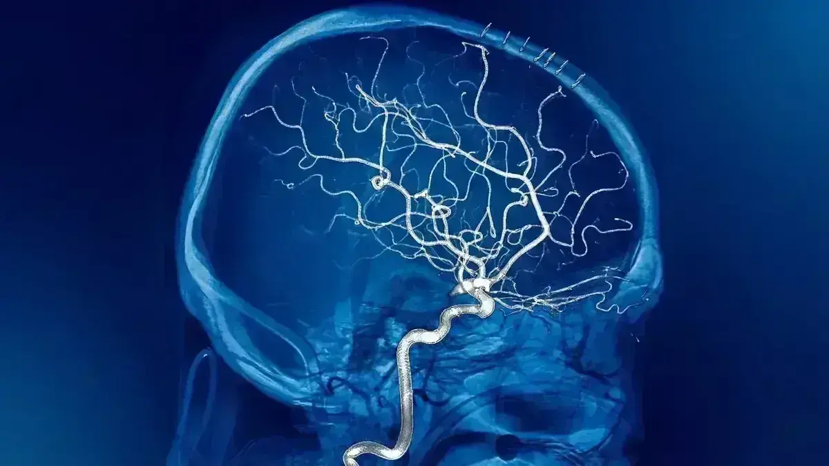 Embolização Endovascular de MAV ou Aneurisma
