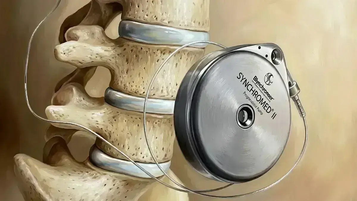 Implante de Bomba de Morfina Intratecal