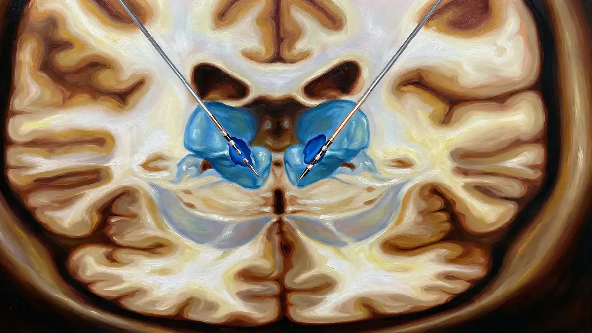 Implante de Estimulador Cerebral Profundo para Epilepsia (DBS no Tálamo Anterior)