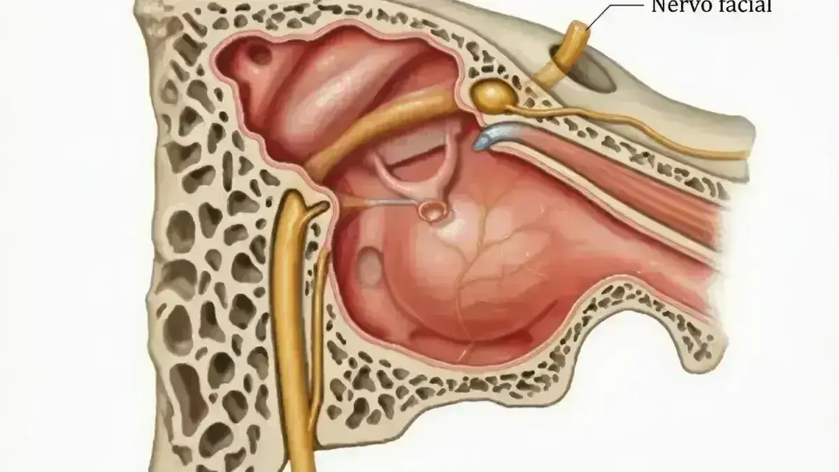 Microdescompressão do Nervo Facial