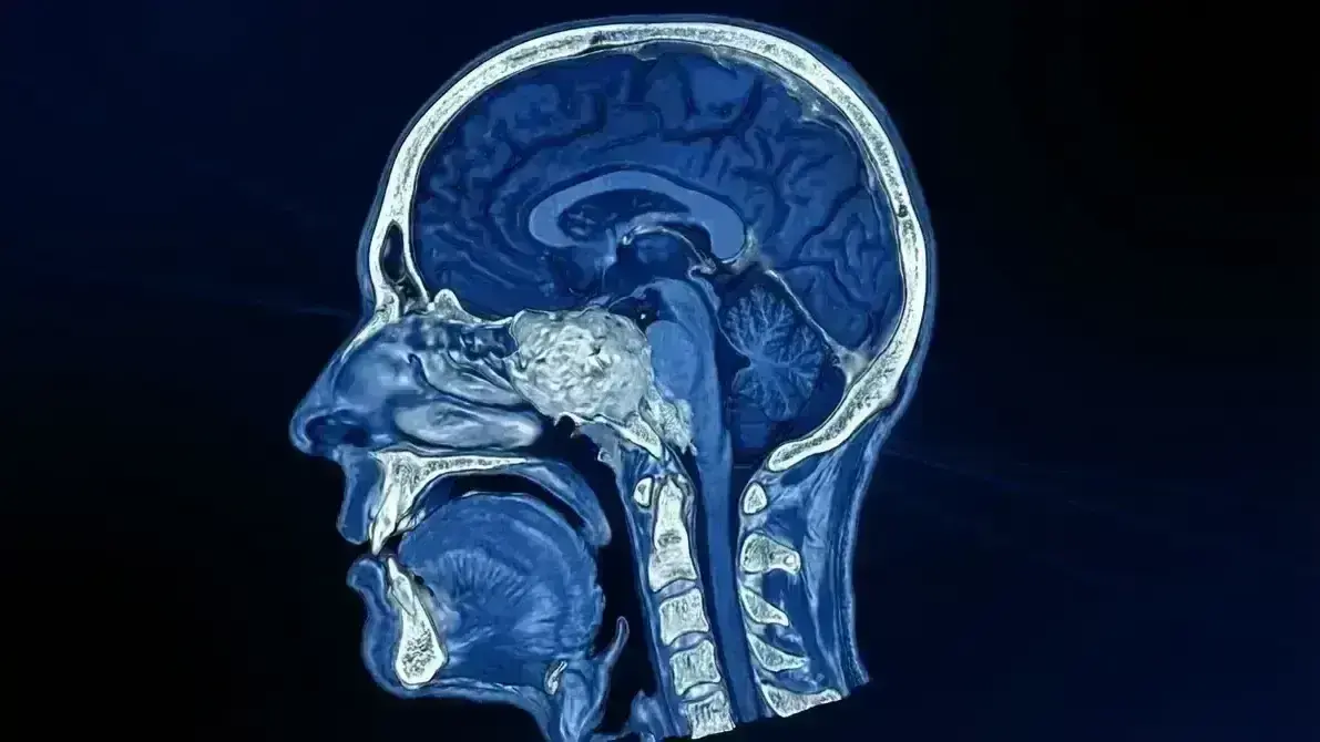 Ressecção de Cordoma de Clivus