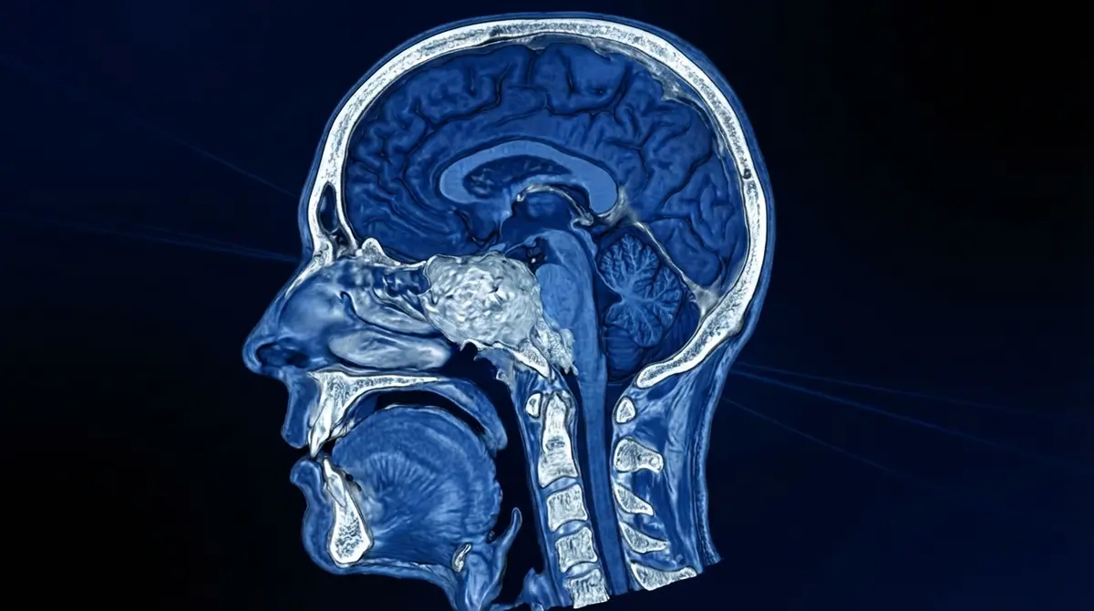 🦴 Ressecção de Cordoma de Clivus