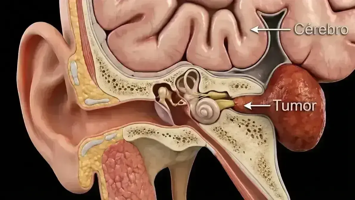 Ressecção de Schwannoma Vestibular