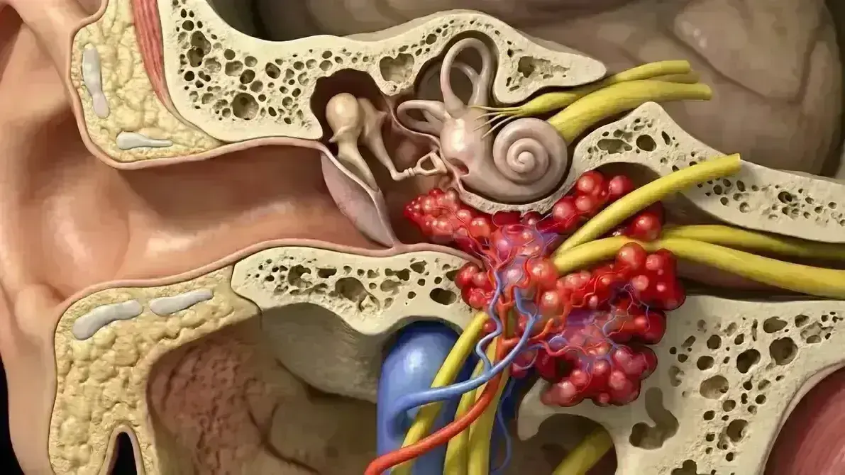 Ressecção de Tumor do Forame Jugular