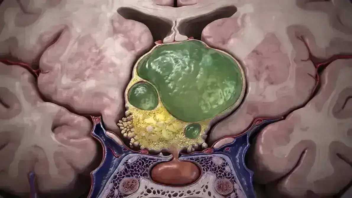 Ressecção de Craniofaringioma