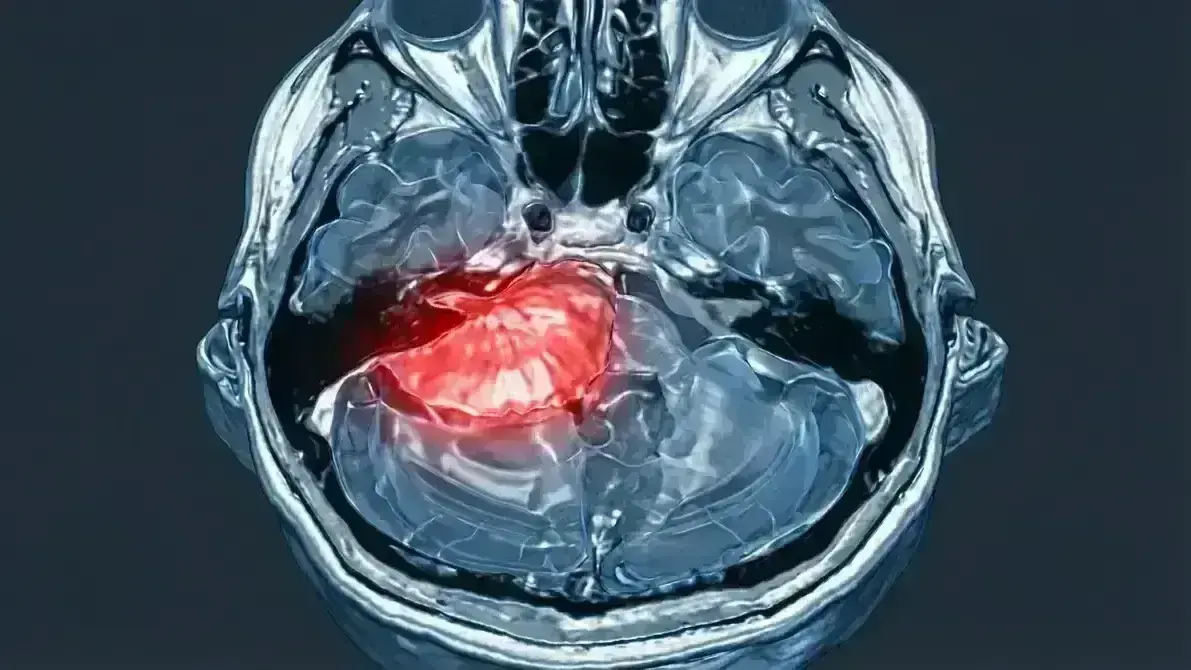 Ressecção de Meningeoma do Ângulo Pontocerebelar