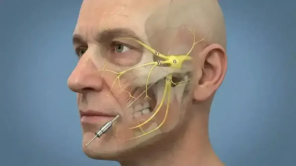 Rizotomia Percutânea do Trigêmeo (Glicerol, Radiofrequência ou Balão)