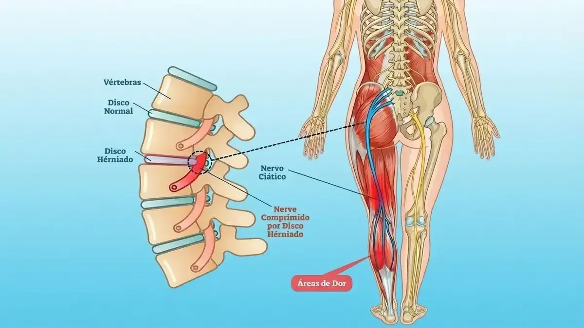 🌿🦵 Radiculopatia Lombar