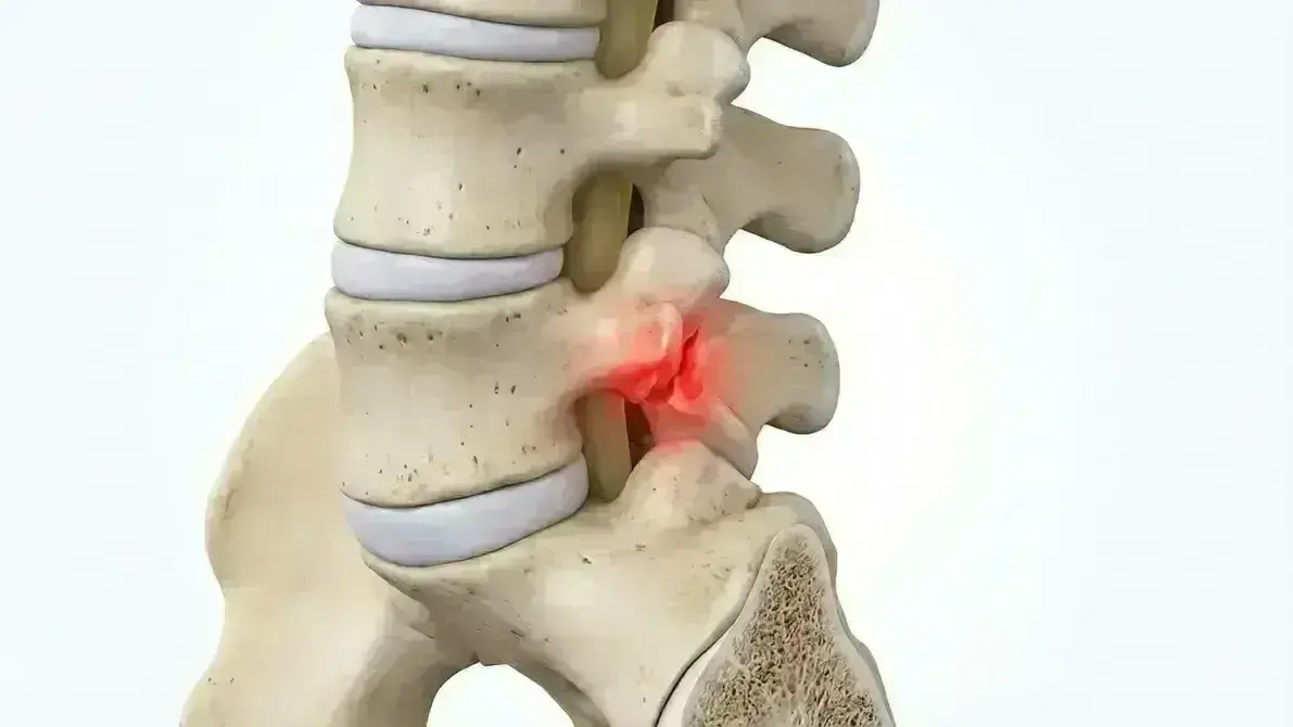 Espondilólise Lombar