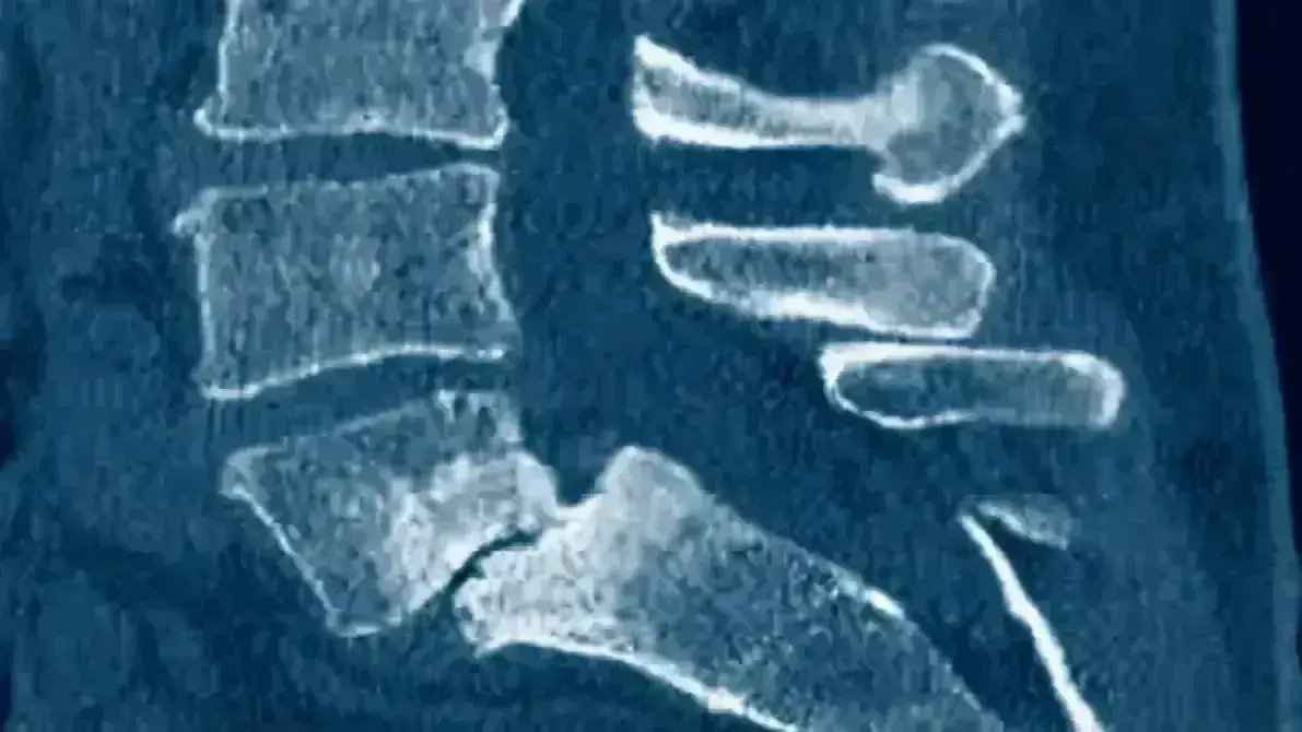 Espondilolistese Ístmica L5–S1