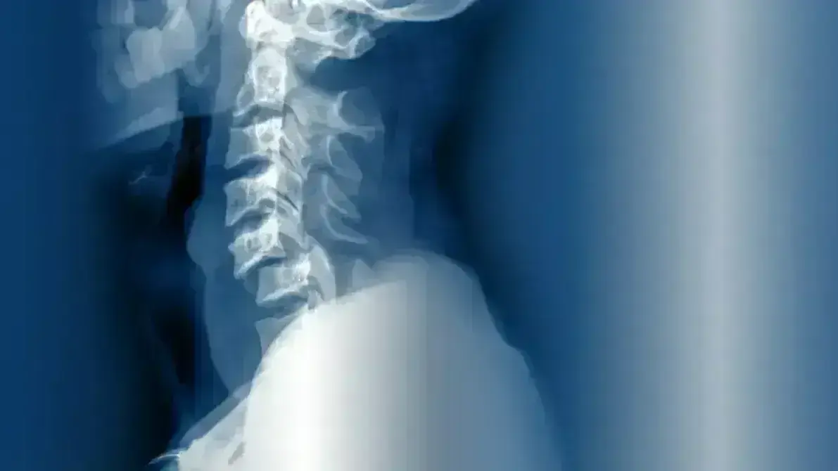 Luxação Cervical Traumática com Compressão Medular