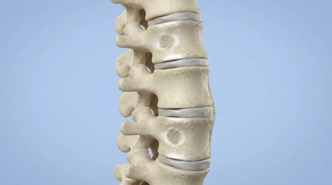 Osteomielite Fúngica Espinhal