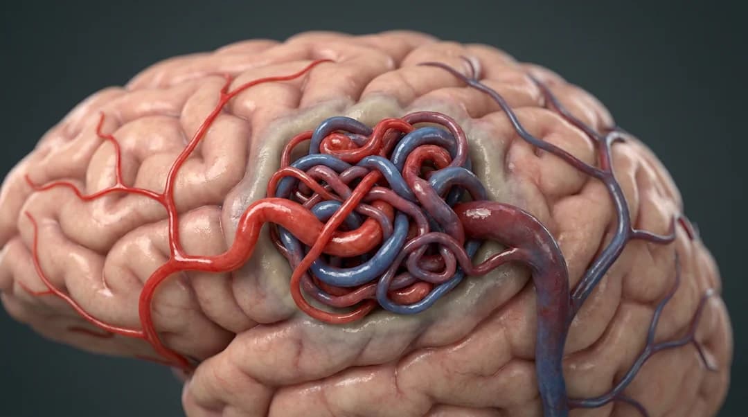 Cefaleia Secundária a Malformação Arteriovenosa (MAV)