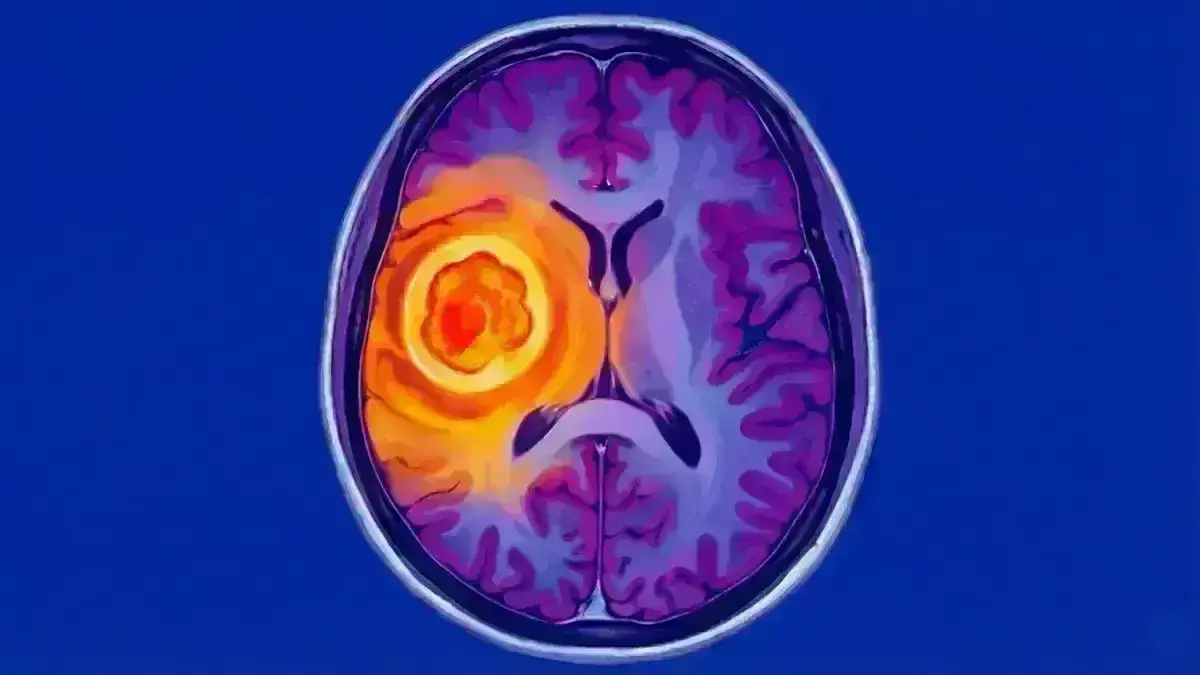 Abscesso Cerebral