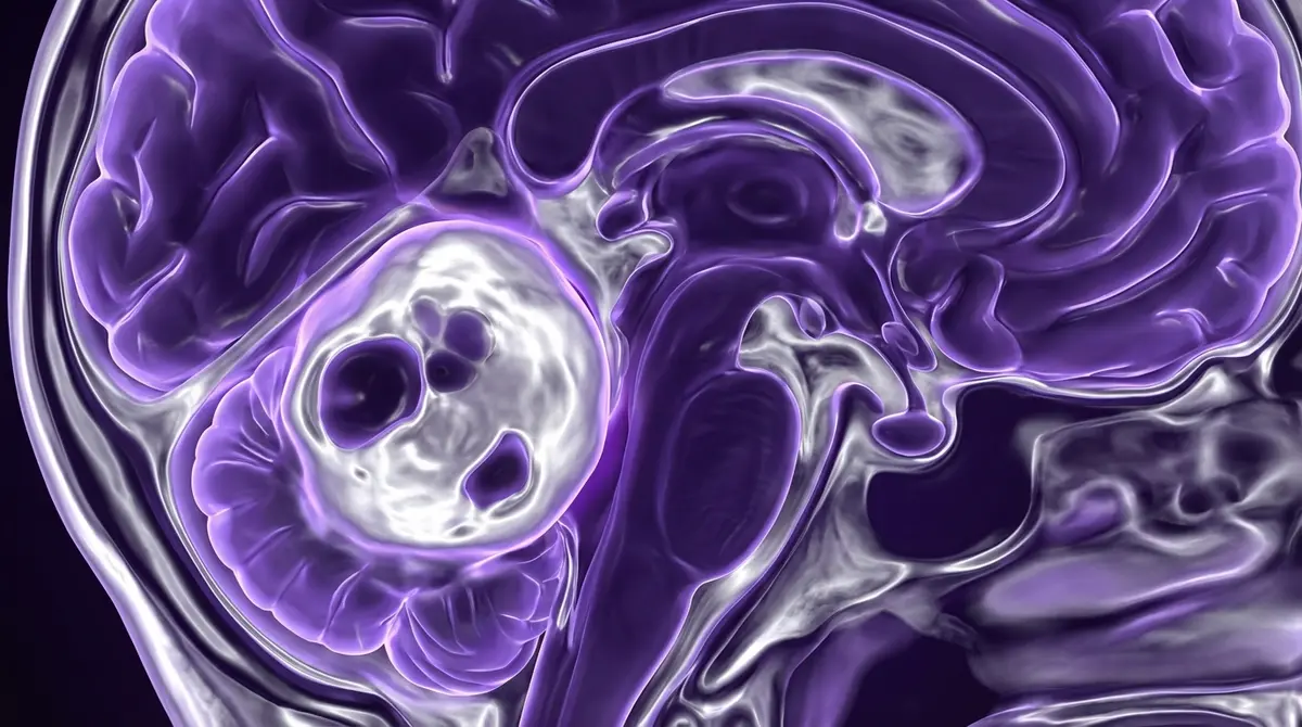 Astrocitoma pilocítico cerebelar