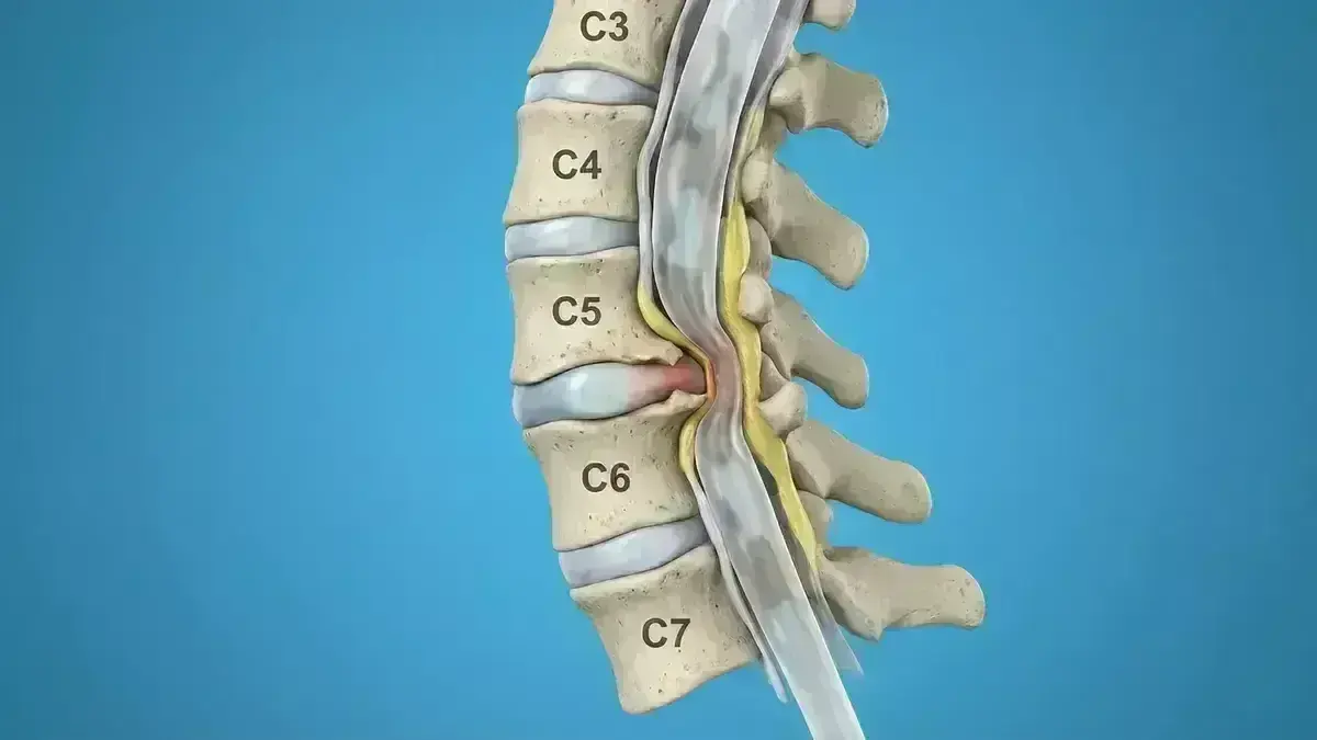 Canal Estreito Cervical (Estenose)