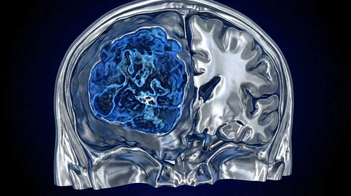 🧠 Ependimoma Supratentorial