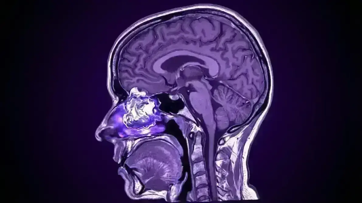 Estesioneuroblastoma