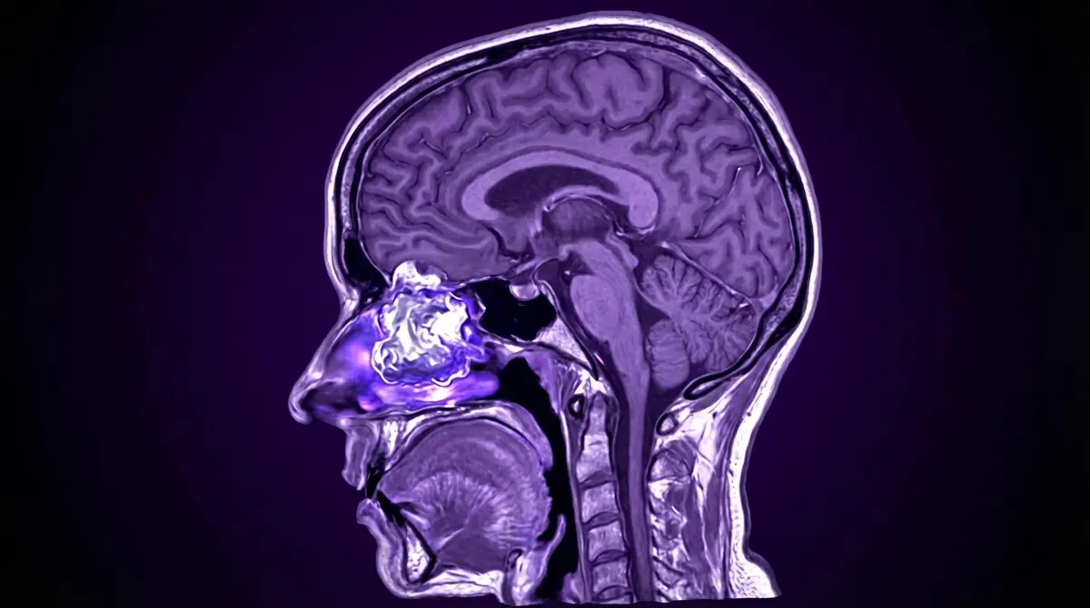 Estesioneuroblastoma