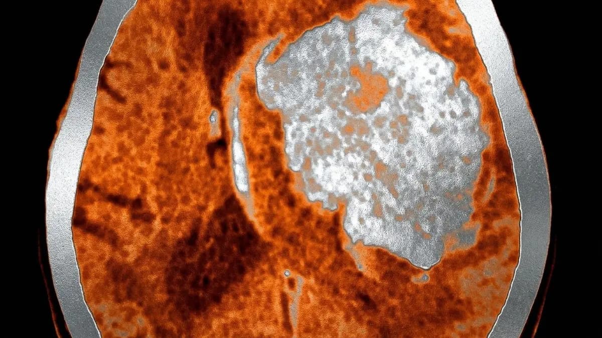 Hemorragia Intraparenquimatosa (HIC)