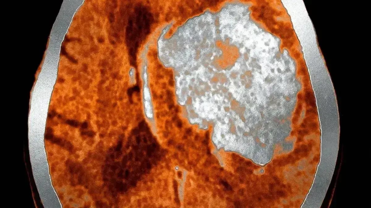 Hemorragia Intraparenquimatosa (HIC)