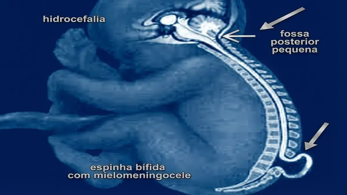 🍼🧠 Malformação de Chiari Tipo II