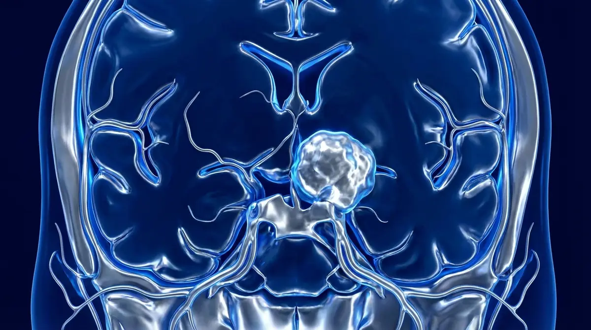 🦴 Meningioma da Clinóide Anterior