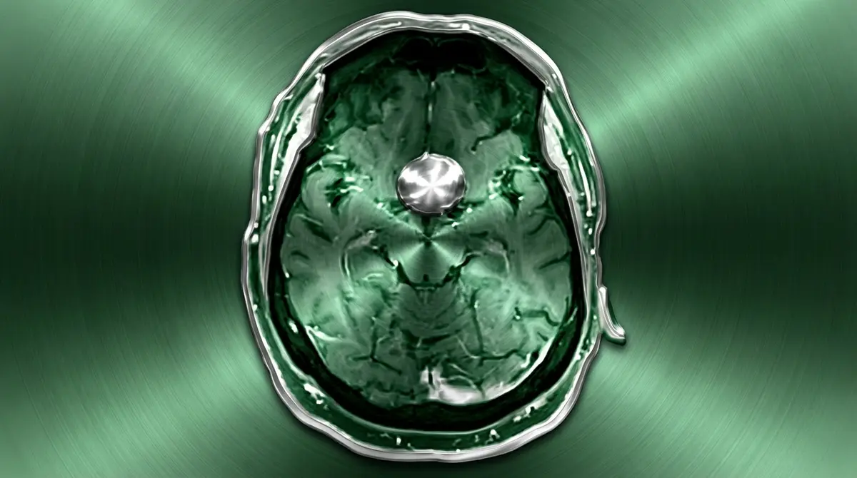 🦴 Meningioma do Tubérculo da Sela