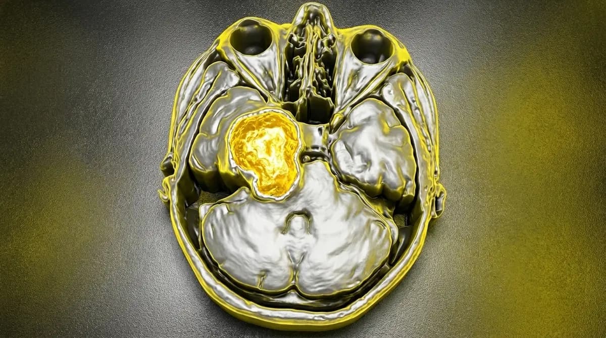 😖 Schwannoma do Nervo Trigêmeo