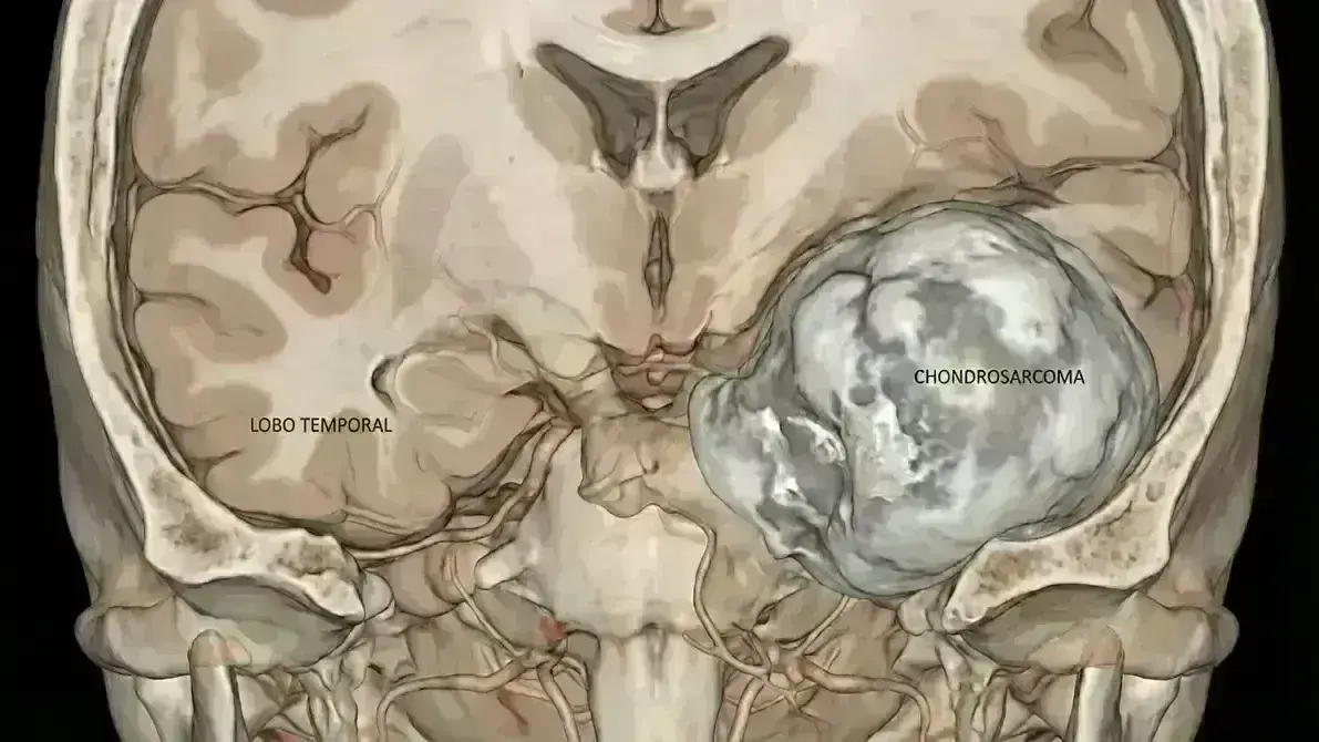 Condrossarcoma de Base do Crânio
