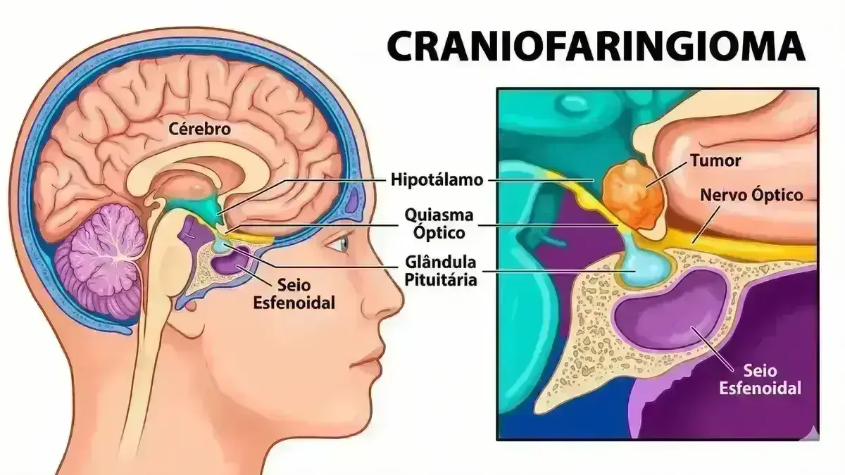 Craniofaringioma