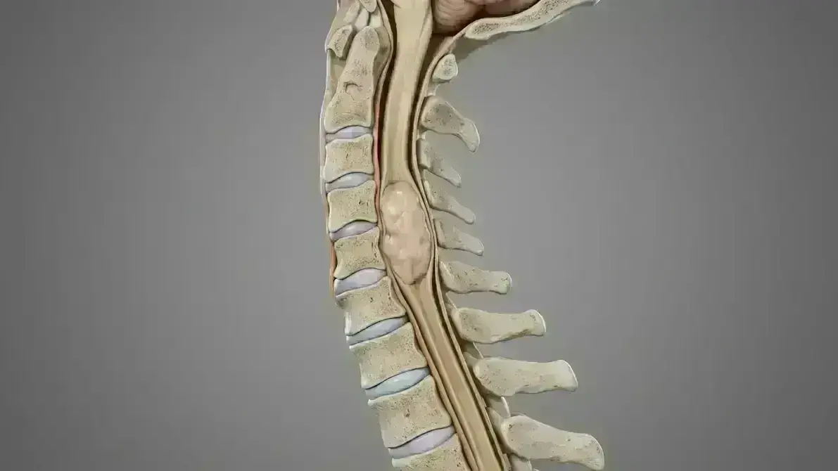 Ependimoma Intramedular Cervical