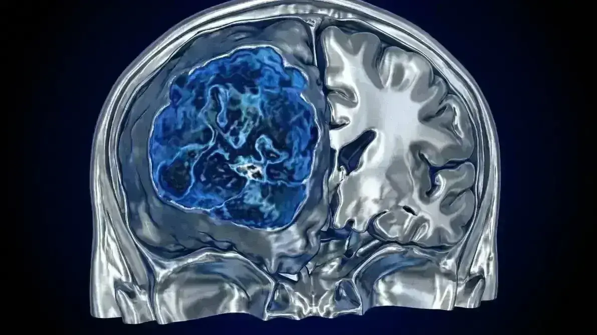 🧠 Ependimoma Supratentorial