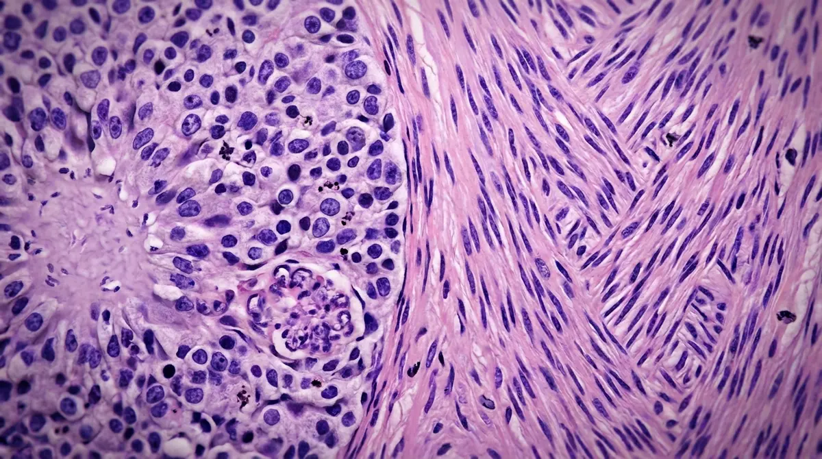 Gliossarcoma