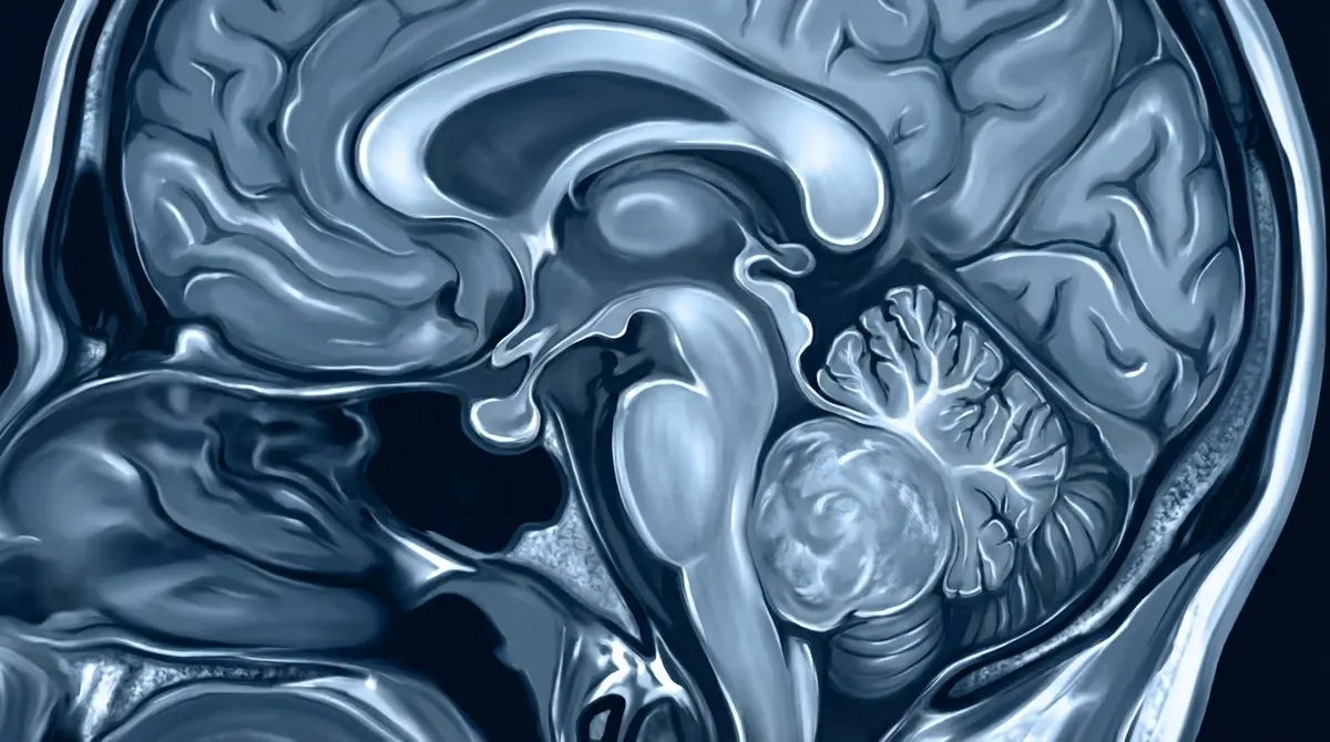 Meduloblastoma Cerebelar