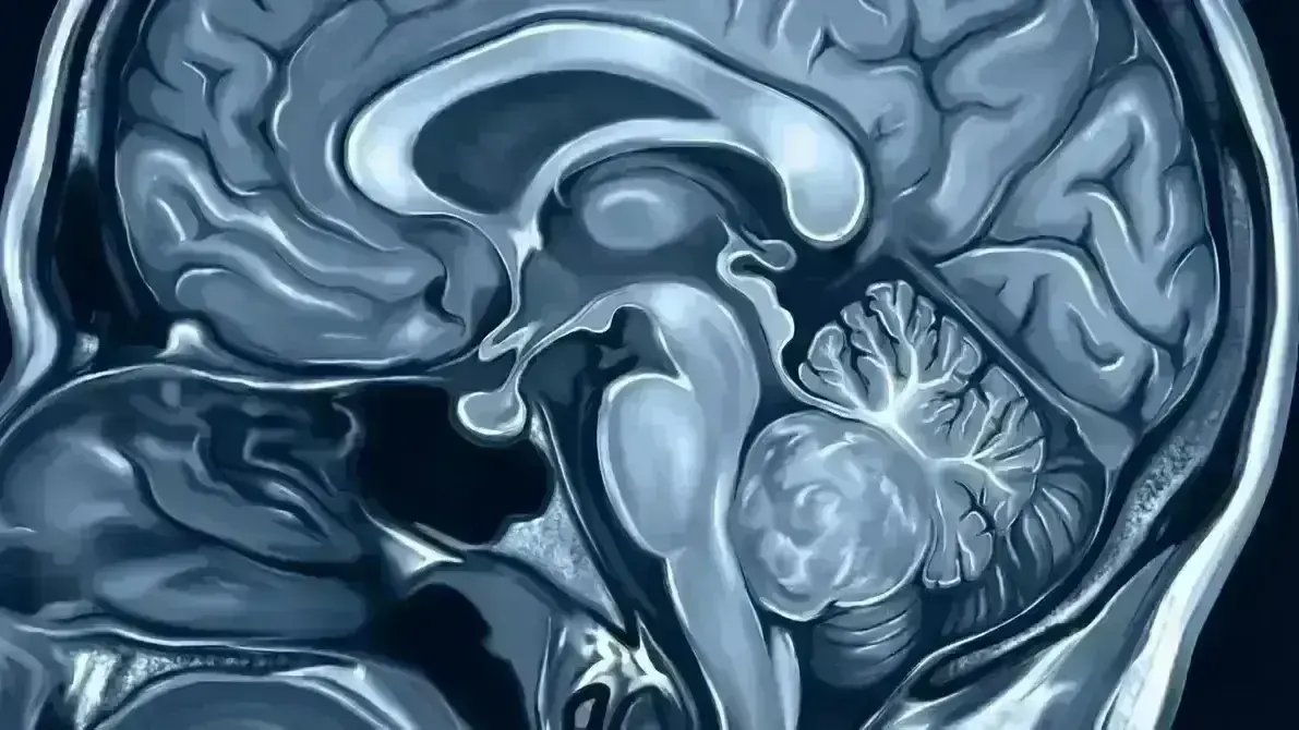 Meduloblastoma Cerebelar