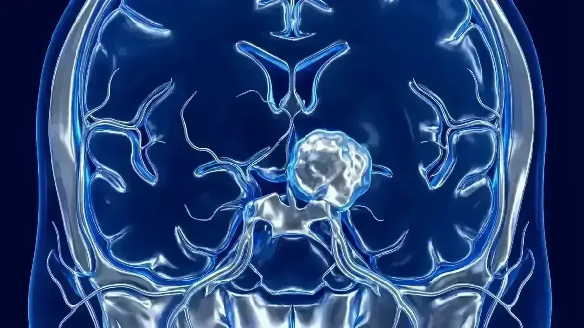 🦴 Meningioma da Clinóide Anterior