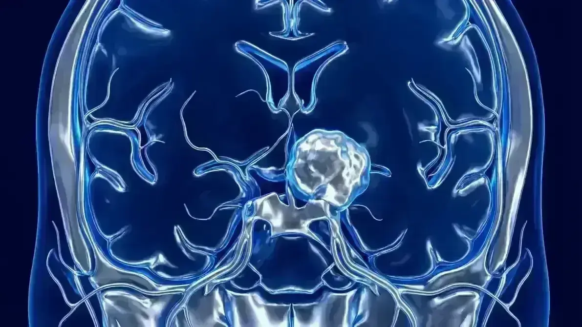 Meningioma da Clinóide Anterior