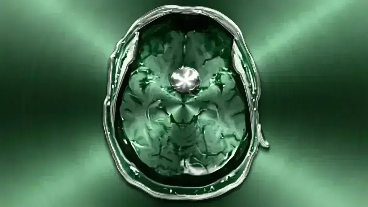 🦴 Meningioma do Tubérculo da Sela