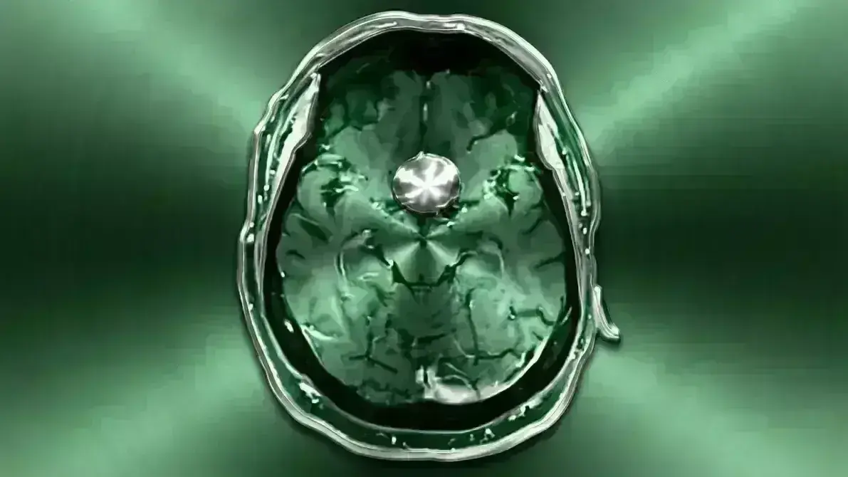 Meningioma do Tubérculo da Sela