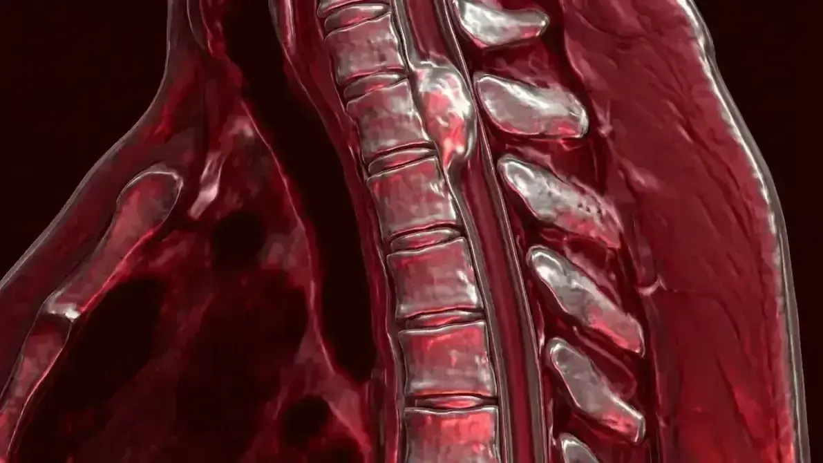 🦴 Meningioma Espinhal Torácico